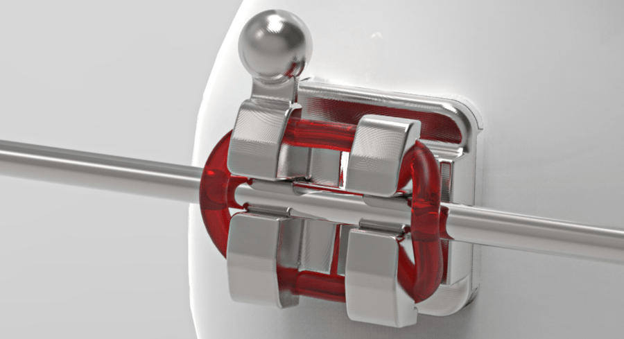 A metal orthodontic bracket with an archwire and red o-ring ligature